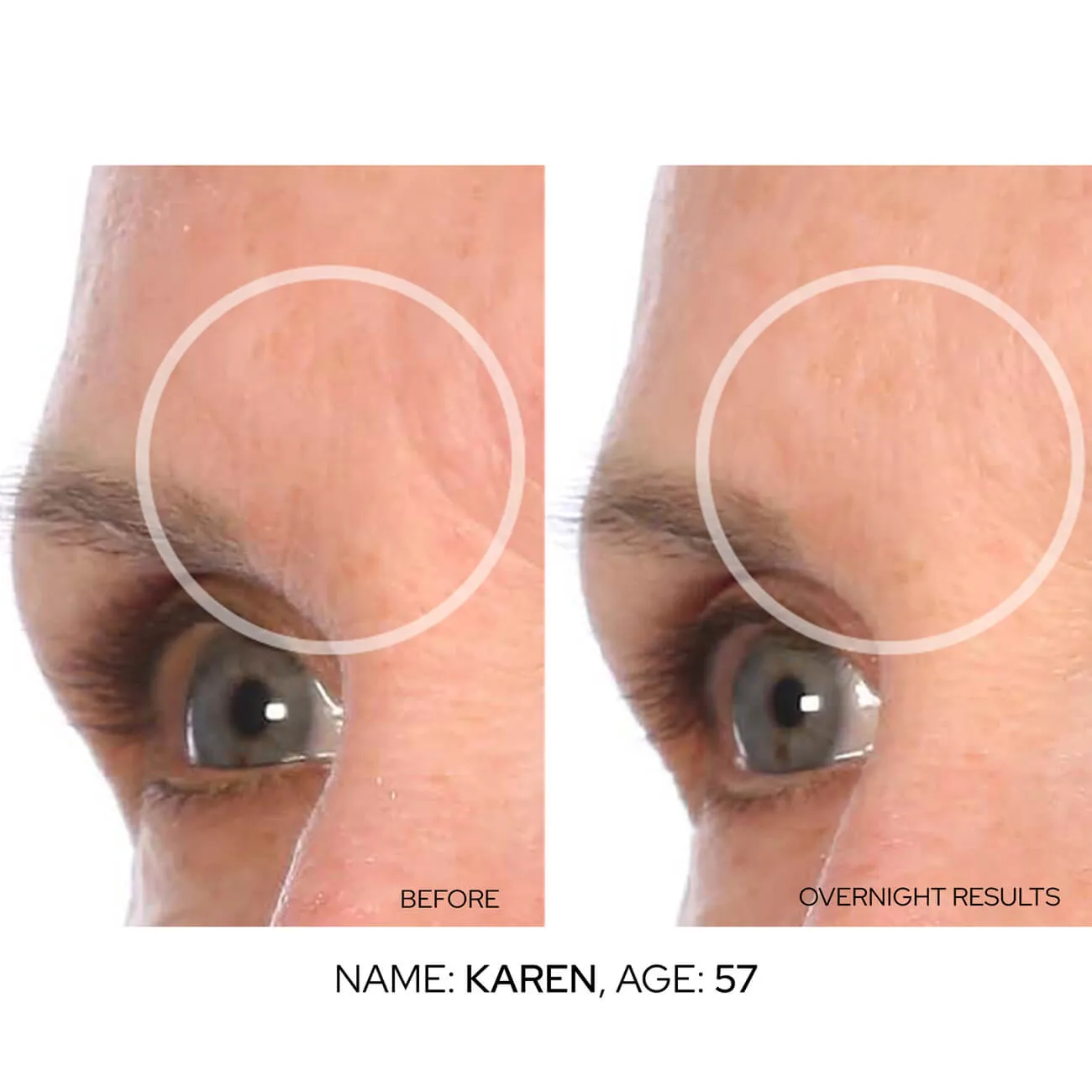 Mid-BrowLift Value Packs